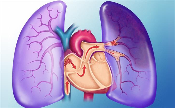 Pulmonary Embolism